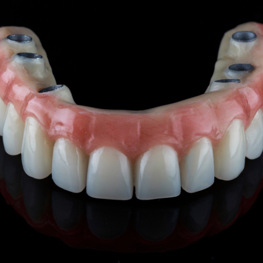 Dental-Implant-Surgery-Costs